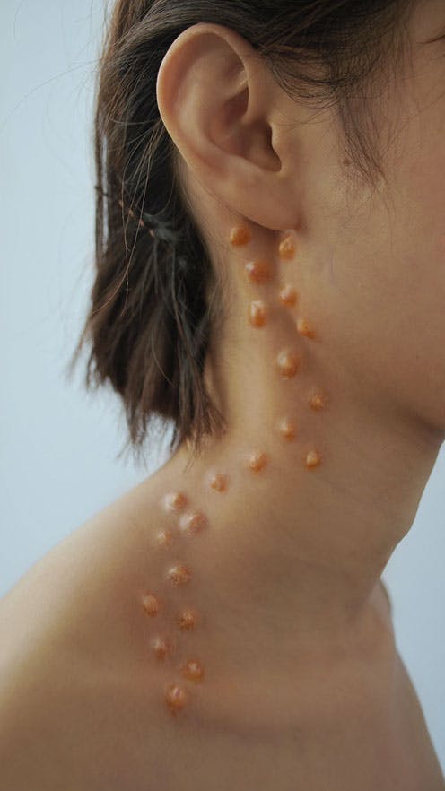 A woman displays a collection of subdermal storage sites on her face and
neck.